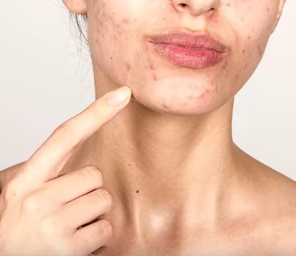 CBD mot akne – Naturlig aknebehandling med olja & krämer